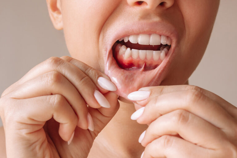 Periodoncia y mantenimiento de encías